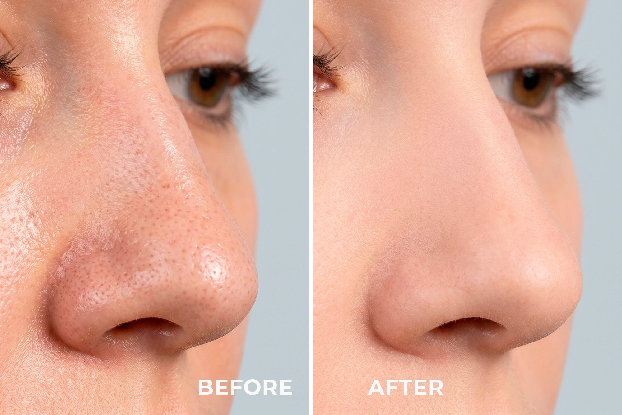 REN - Esfoliador Facial Ultra-sónico