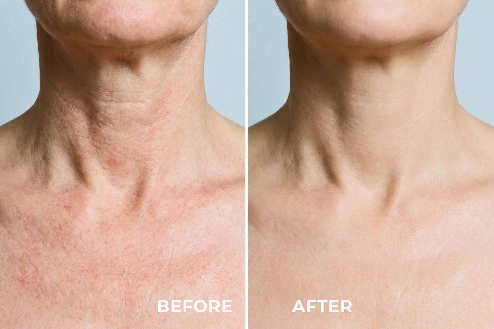 LED NECK MASK 2.0 - MASCHERA FOTOTERAPICA PER LA ZONA COLLO E DECOLLETE'